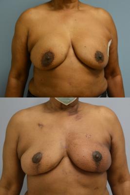 Before(top pic) After (bottom pic): Breast Reconstruction