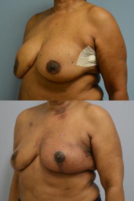 Before(top pic) After (bottom pic): Breast Reconstruction