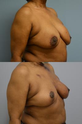 Before(top pic) After (bottom pic): Breast Reconstruction