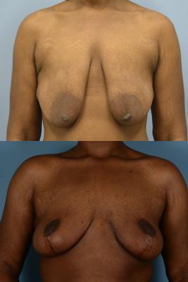 Before (top pic) After (bottom pic): Breast Lift