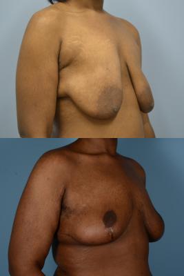Before(top pic) After (bottom pic): Breast Lift