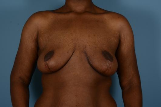 After: breast lift