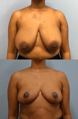 Before(top pic) After (bottom pic): Breast Reduction