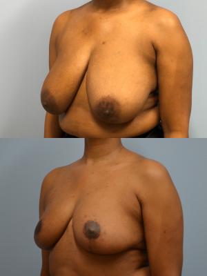 Before(top pic) After (bottom pic): Breast Reduction