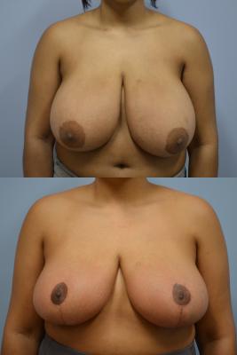 Before(top pic) After (bottom pic): Breast Reduction