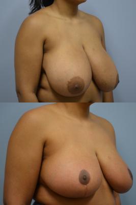 Before(top pic) After (bottom pic): Breast Reduction