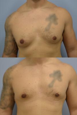 Before(top pic) After (bottom pic): Gynecomastia