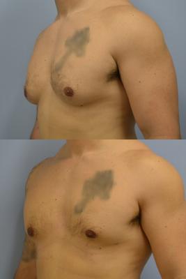Before(top pic) After (bottom pic): Gynecomastia