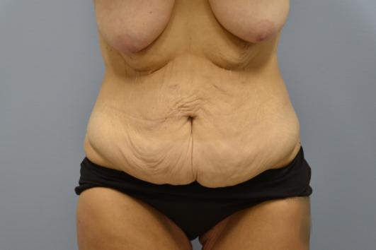 Before: Abdominoplasty