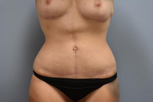 After: Abdominoplasty