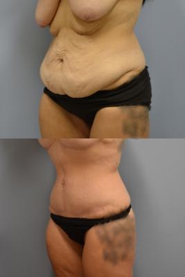 Before(top pic) After (bottom pic): Abdominoplasty