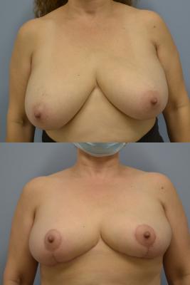 Before(top pic) After (bottom pic): Breast Reduction