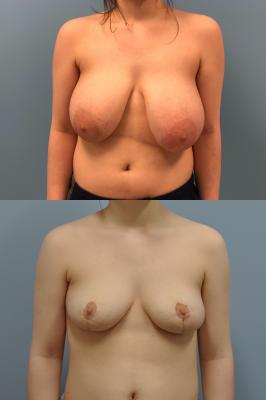 Before(top pic) After (bottom pic): Breast Reduction