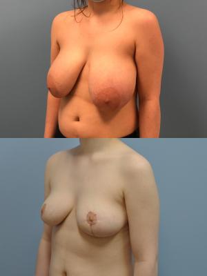 Before(top pic) After (bottom pic): Breast Reduction