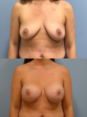 Before(top pic) After (bottom pic): Breast Reconstruction