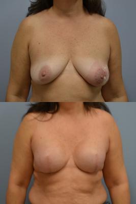 Before(top pic) After (bottom pic): Breast Reconstruction