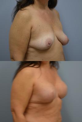 Before(top pic) After (bottom pic): Breast Reconstruction