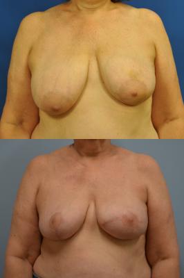 Before(top pic) After (bottom pic): Breast Reconstruction