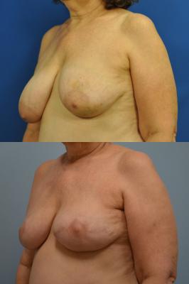 Before(top pic) After (bottom pic): Breast Reconstruction