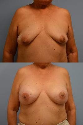 Before(top pic) After (bottom pic): Breast Reconstruction