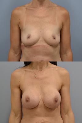 Before(top pic) After (bottom pic): Breast Reconstruction