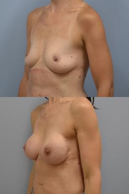 Before(top pic) After (bottom pic): Breast Reconstruction