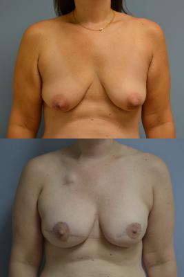 Before(top pic) After (bottom pic): Breast Reconstruction