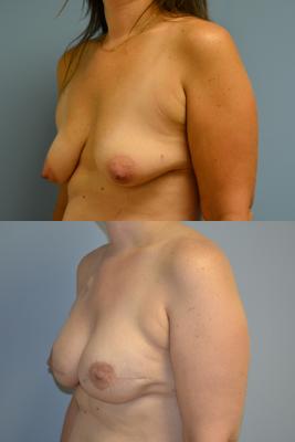 Before(top pic) After (bottom pic): Breast Reconstruction