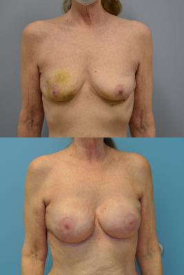 Before(top pic) After (bottom pic): Breast Reconstruction