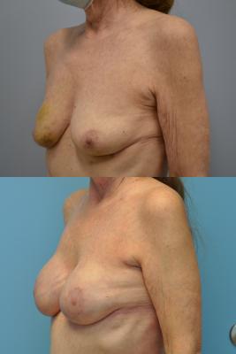 Before(top pic) After (bottom pic): Breast Reconstruction