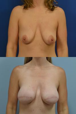 Before(top pic) After (bottom pic): Breast Reconstruction