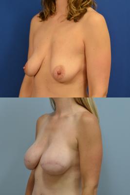 Before(top pic) After (bottom pic): Breast Reconstruction