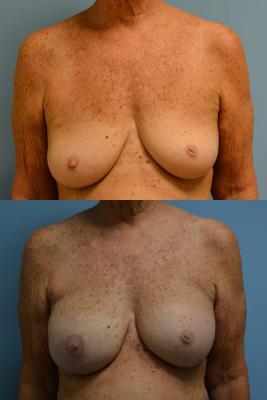 Before(top pic) After (bottom pic): Breast Reconstruction