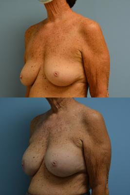 Before(top pic) After (bottom pic): Breast Reconstruction