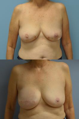 Before(top pic) After (bottom pic): Breast Reconstruction