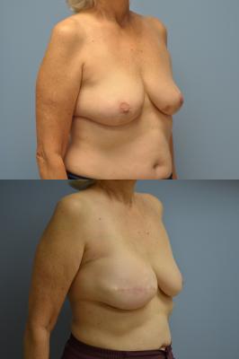 Before(top pic) After (bottom pic): Breast Reconstruction