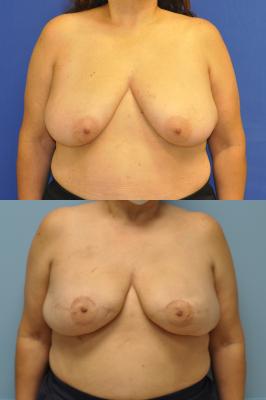 Before(top pic) After (bottom pic): Breast Reconstruction