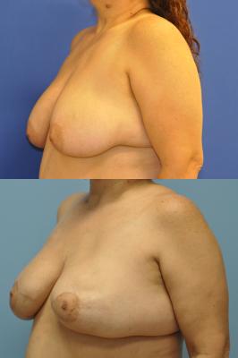 Before(top pic) After (bottom pic): Breast Reconstruction