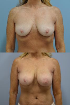 Before(top pic) After (bottom pic): Breast Reconstruction