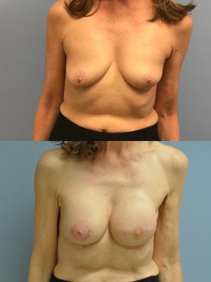 Before(top pic) After (bottom pic): Breast Reconstruction