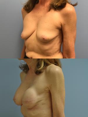 Before(top pic) After (bottom pic): Breast Reconstruction