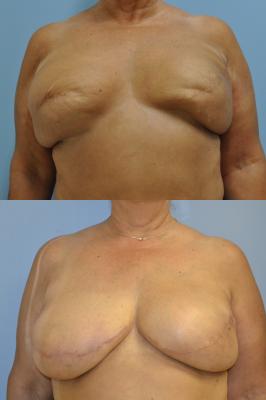 Before(top pic) After (bottom pic): Breast Reconstruction