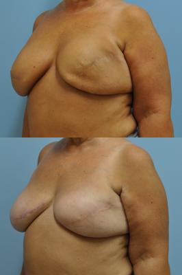 Before(top pic) After (bottom pic): Breast Reconstruction