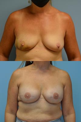 Before(top pic) After (bottom pic): Breast Reconstruction