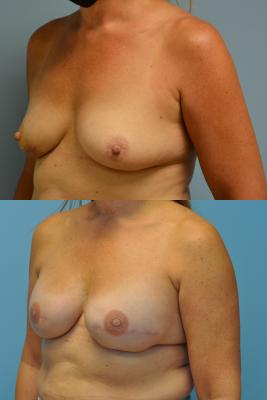 Before(top pic) After (bottom pic): Breast Reconstruction