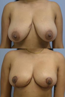 Before(top pic) After (bottom pic): Left oncoplastic reduction, Right reduction for symmetry