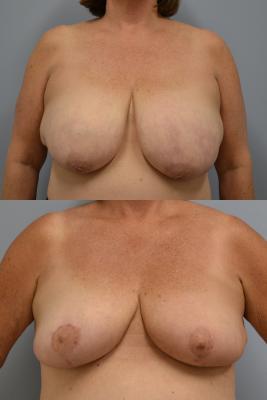 Before(top pic) After (bottom pic): Oncoplastic Reduction