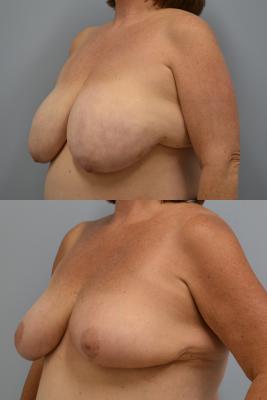 Before(top pic) After (bottom pic): Oncoplastic Reduction