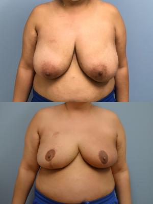 Before(top pic) After (bottom pic): Oncoplastic Breast Reduction