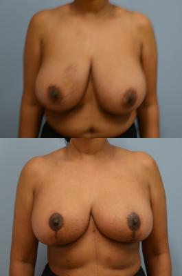 Before(top pic) After (bottom pic): Oncoplastic Breast Reduction